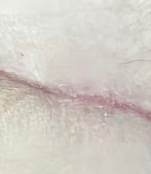 Surgical · healed — before using Glowtivated