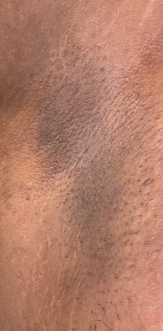 Underarm · hyperpigmentation — after using Glowtivated