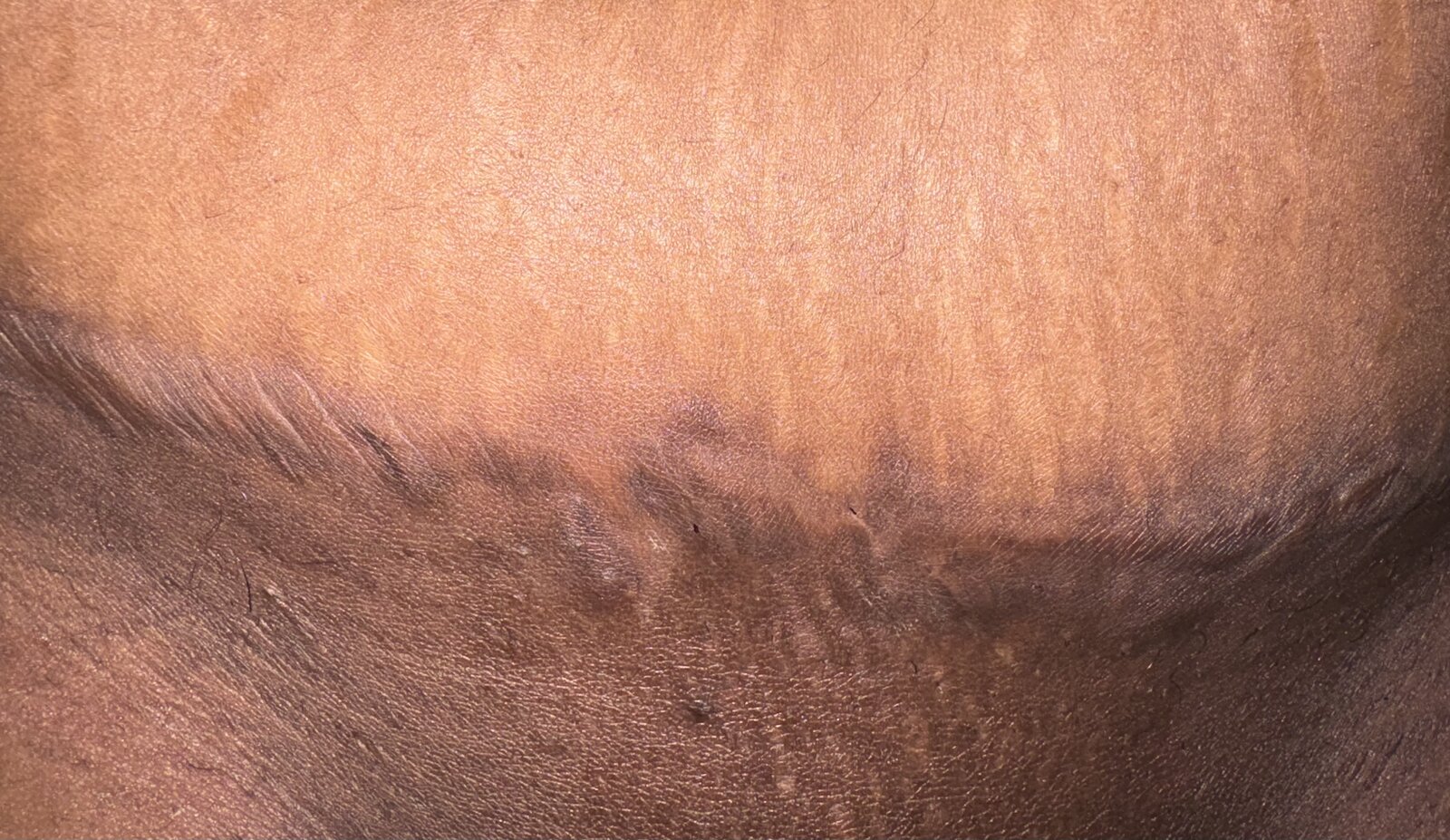 Stretch marks · tone + texture — after using Glowtivated