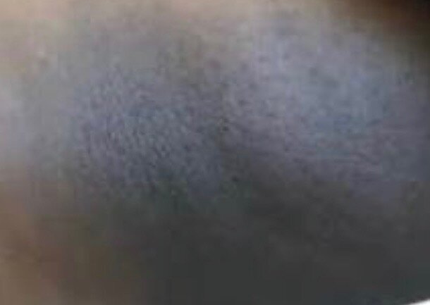 Knee · dark patch — before using Glowtivated