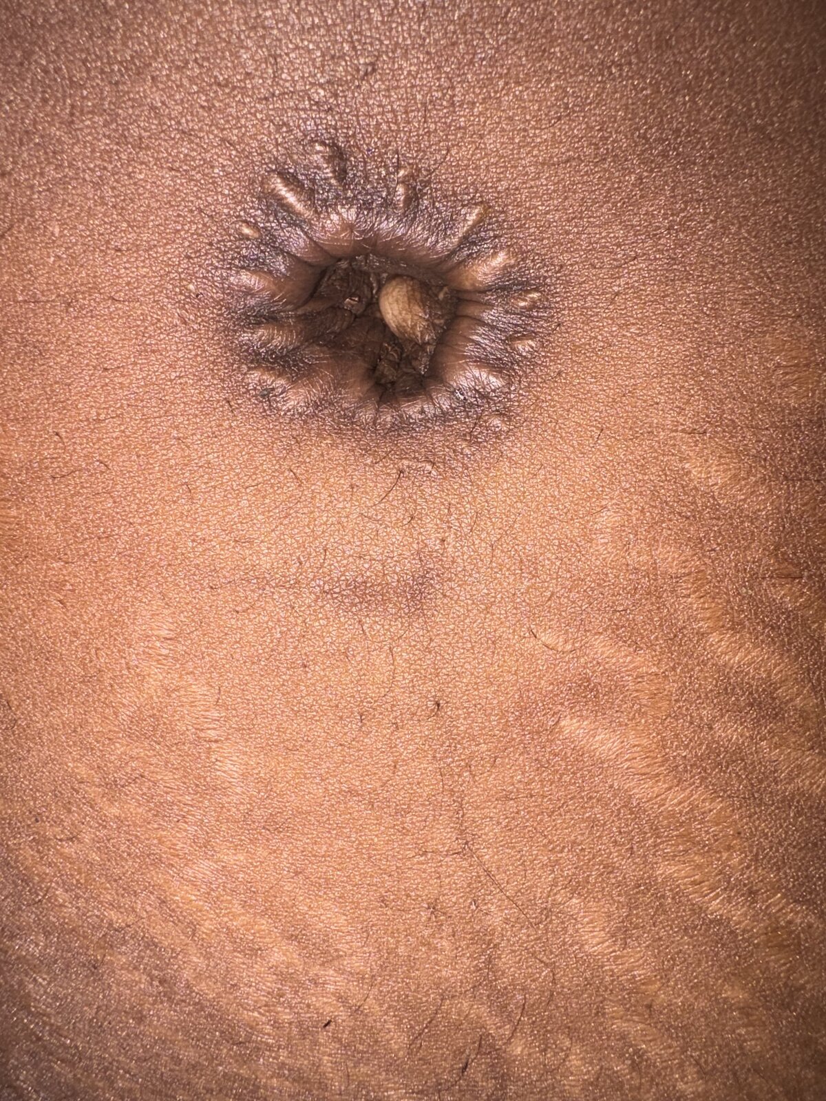 Belly button · keloid — before using Glowtivated