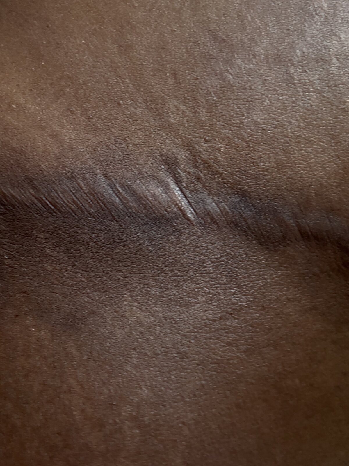 C-section · 4 yr old scar — after using Glowtivated
