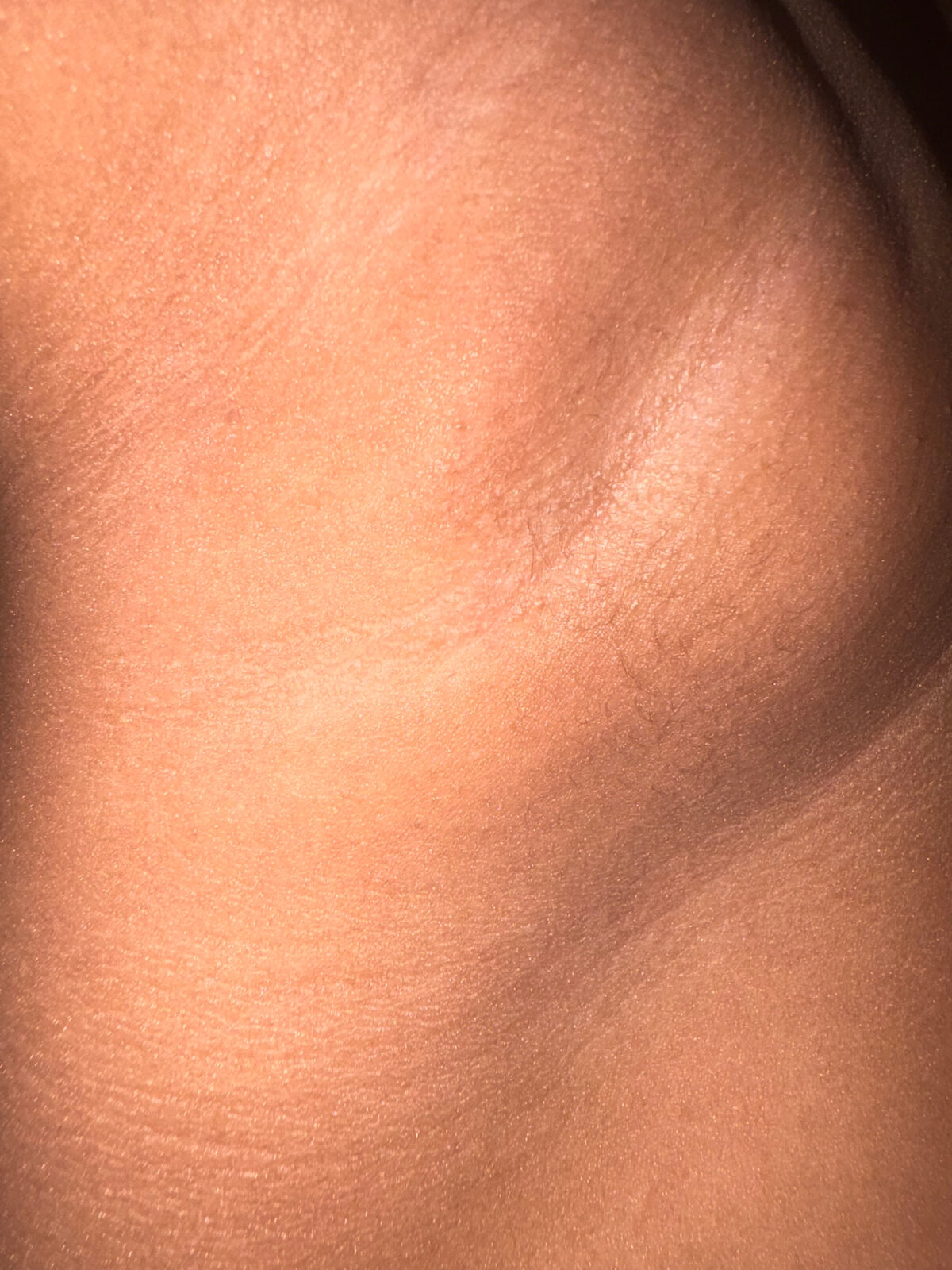 Inner thigh · hyperpigmentation — after using Glowtivated