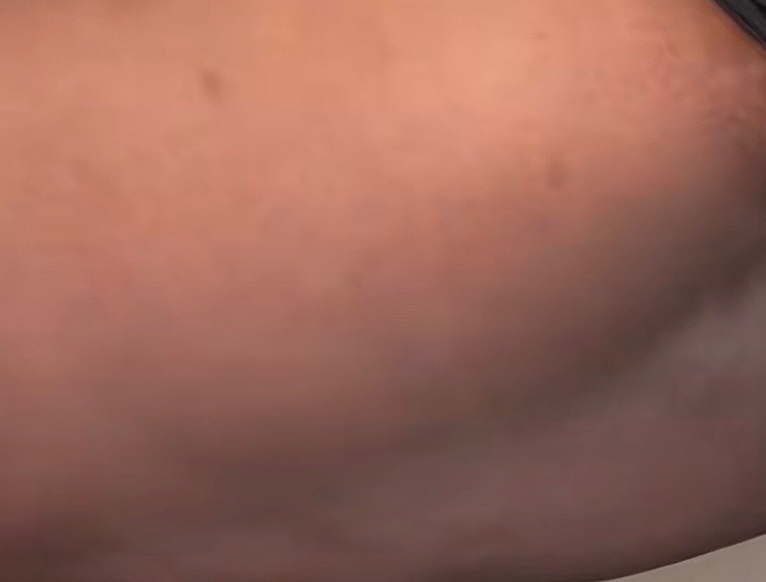 Knee · dark patch — after using Glowtivated