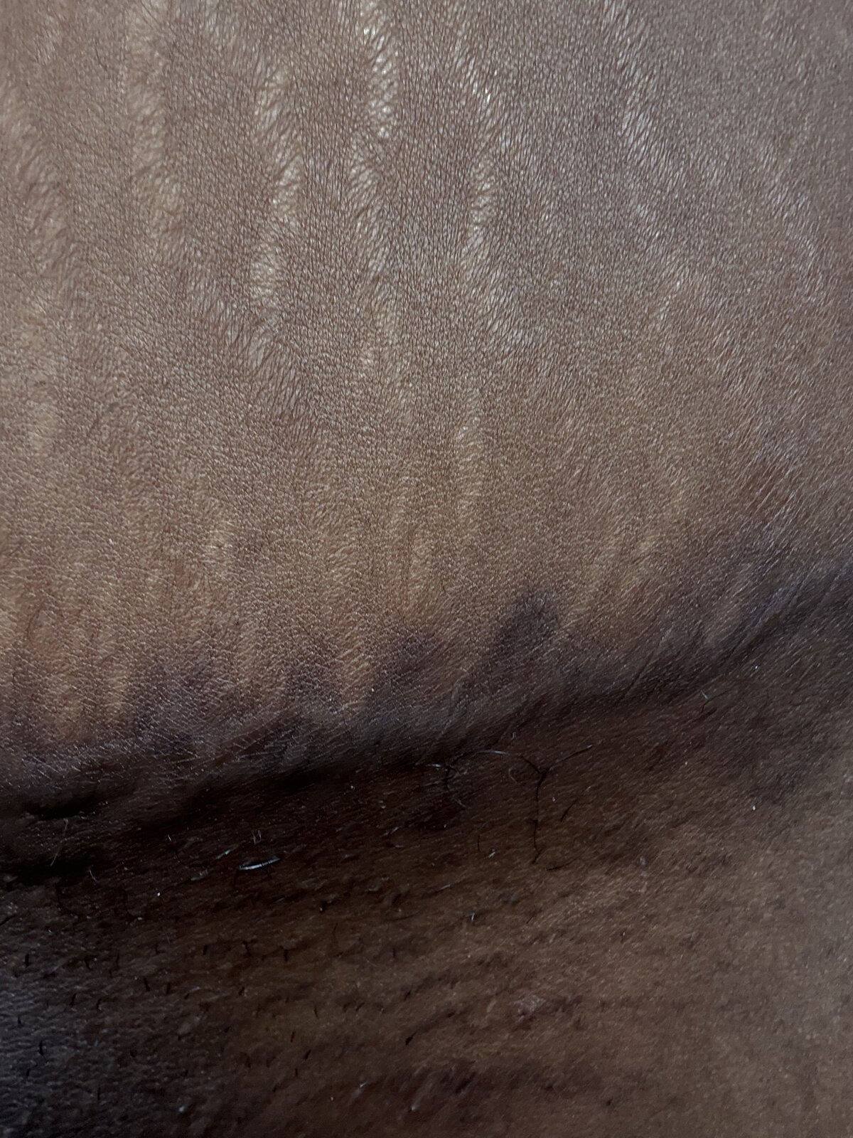 C-section · 4 yr old scar — before using Glowtivated