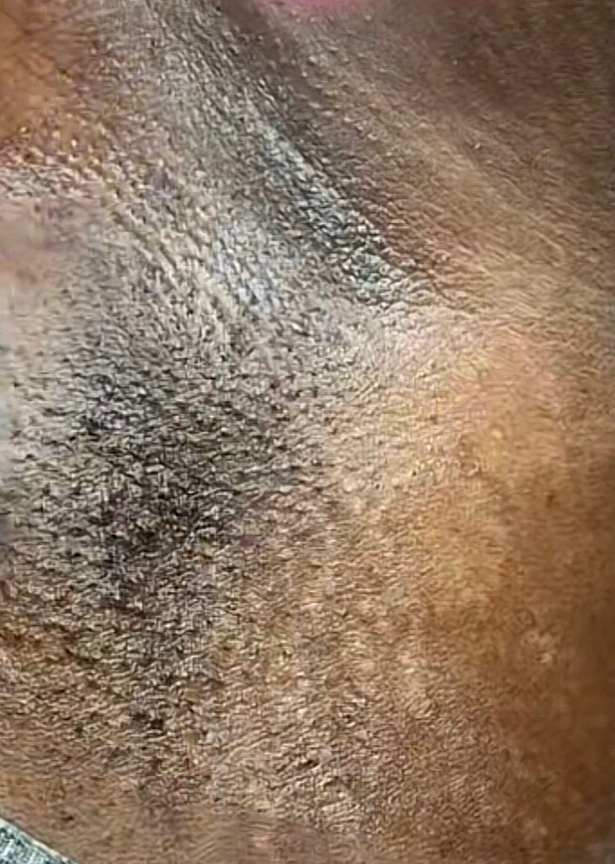 Underarm · hyperpigmentation — before using Glowtivated