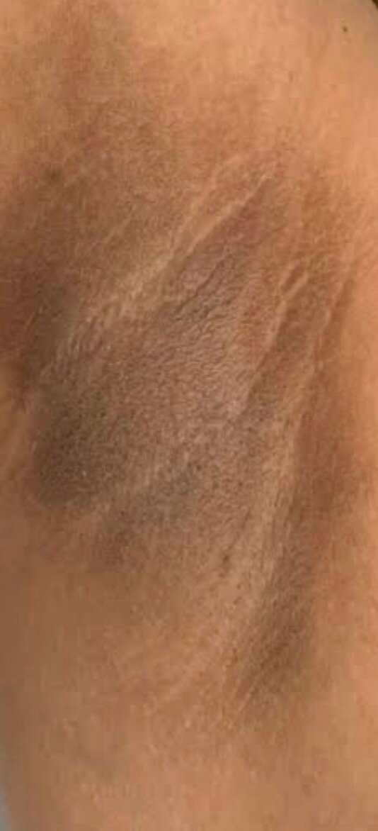 Inner thigh · hyperpigmentation — before using Glowtivated