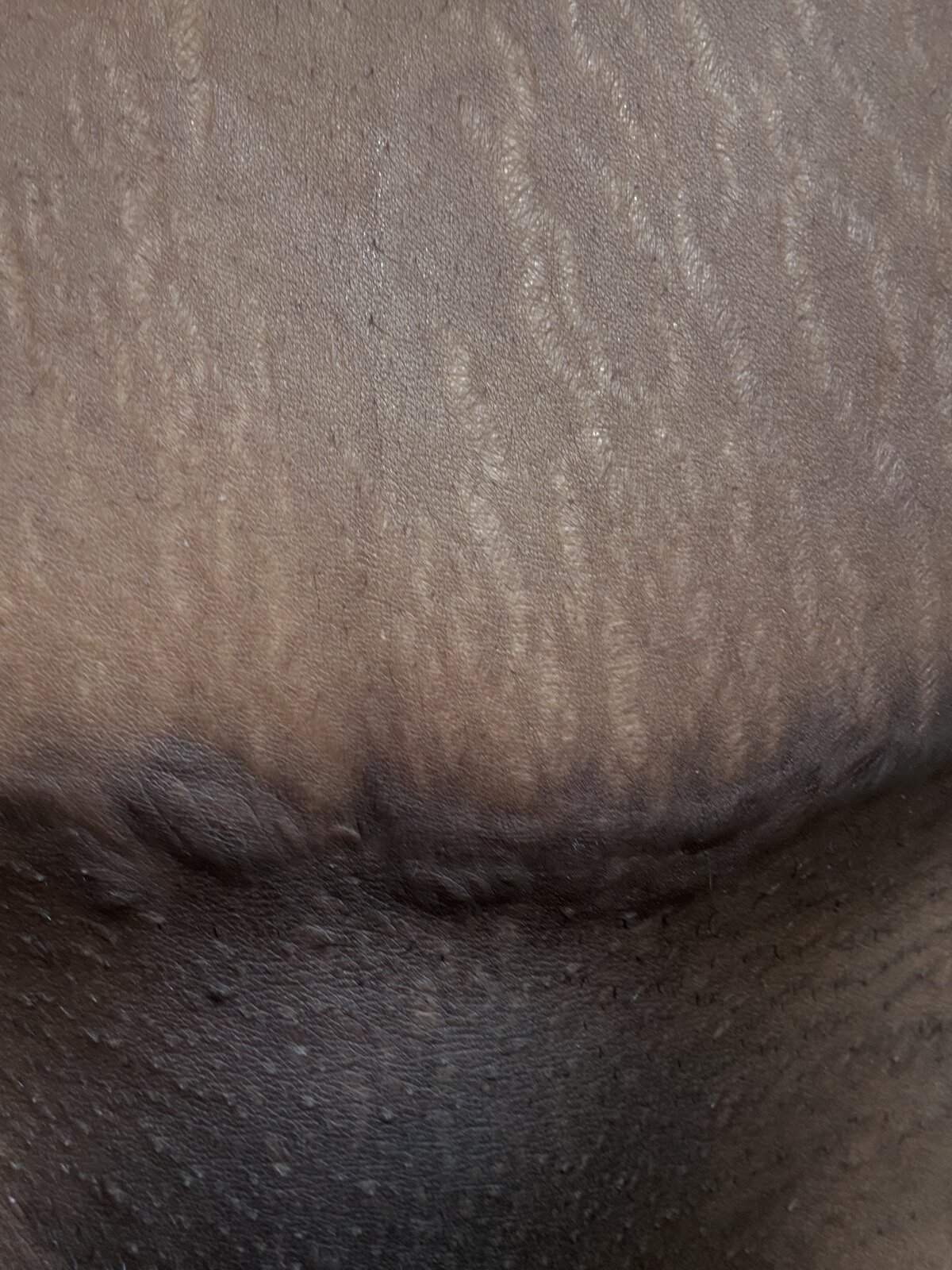 Stretch marks · tone + texture — before using Glowtivated