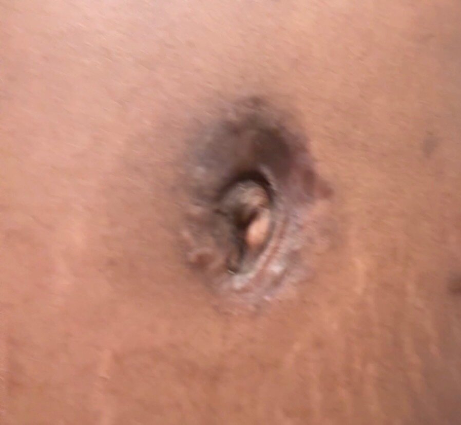 Belly button · keloid — after using Glowtivated