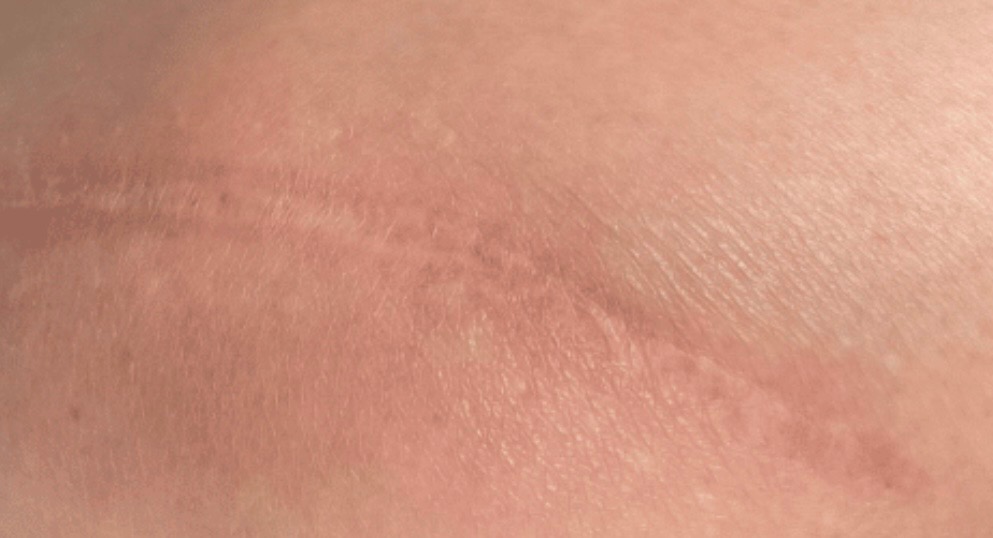 Surgical · healed — after using Glowtivated