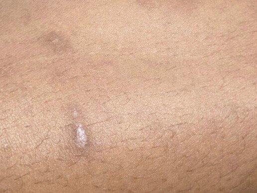 Leg scar · faded flat — before using Glowtivated